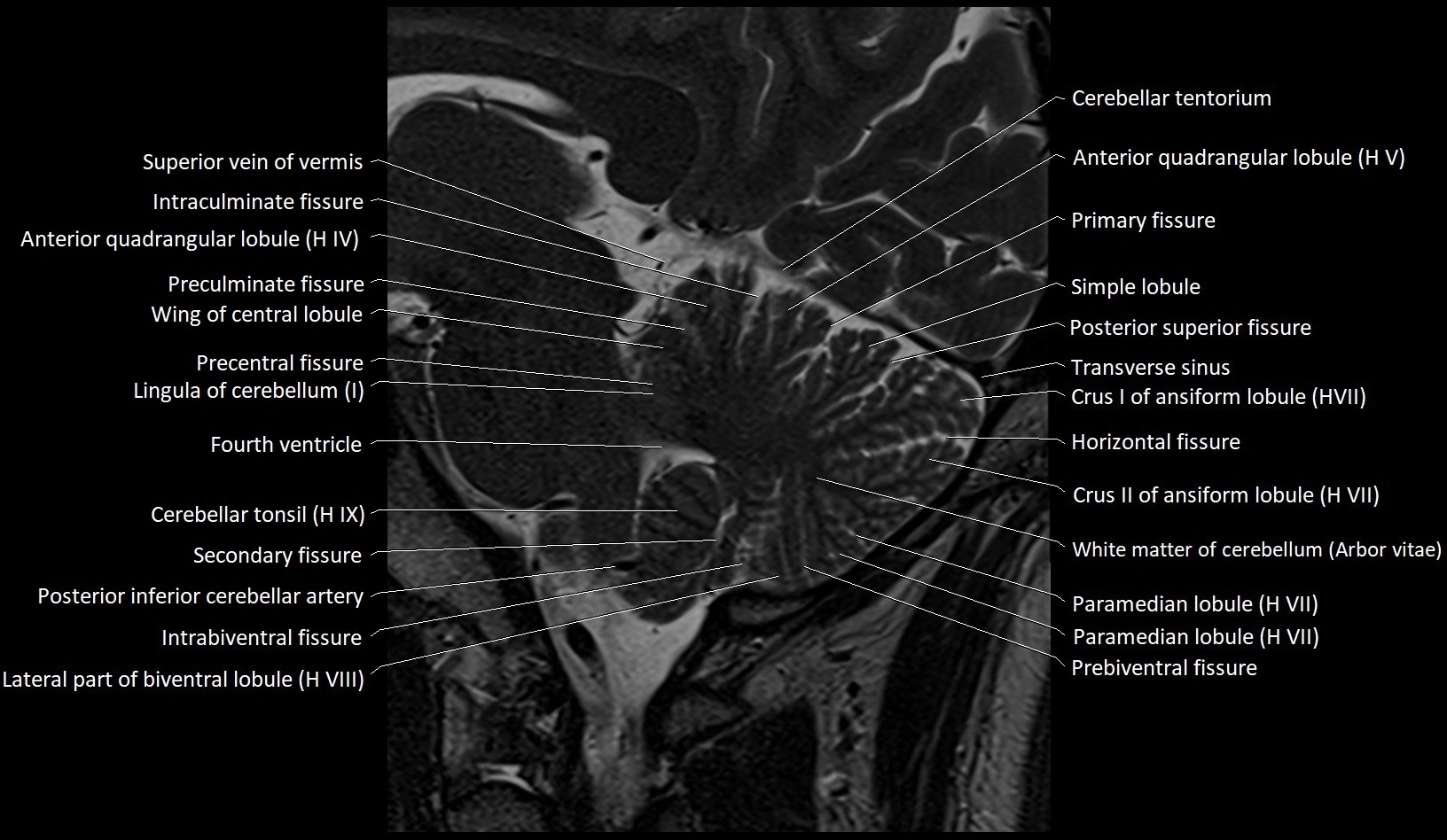 MRI Cerebellar anatomy sagittal High-resolution labelled image 33.webp